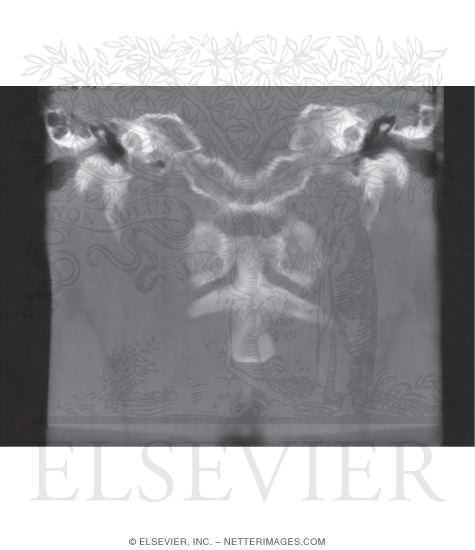 CT Image: Coronal View