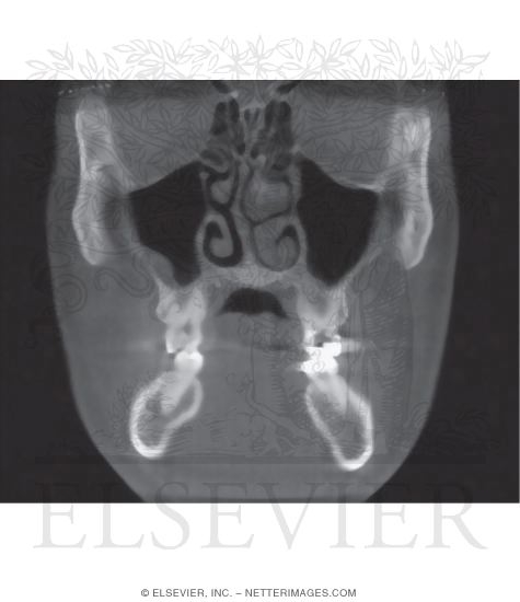 Watermarked preview of unlabeled image: CT Image: Coronal View