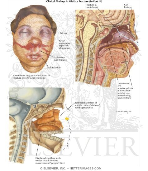 Watermarked preview of labeled image: Facial Trauma: Clinical Findings In Mid-Face Fracture
