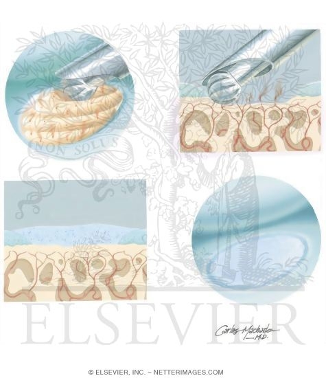 Watermarked preview of unlabeled image: Surgical Procedures for Preservation of Articular Surface