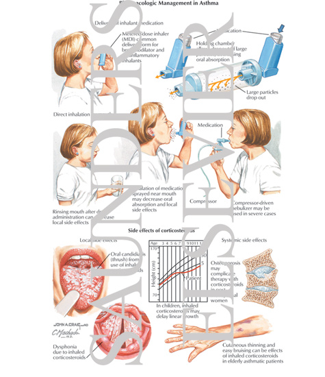Watermarked preview of labeled image: Pharmacologic Management In Asthma, Side Effects of Corticosteroids
