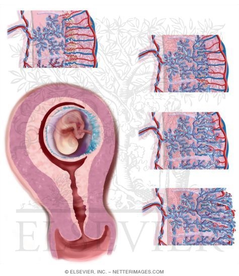Watermarked preview of unlabeled image: Abnormalities of Placental Implantation