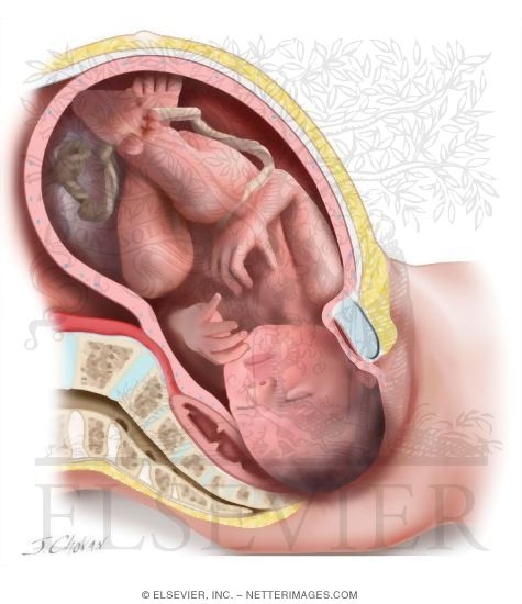 Watermarked preview of unlabeled image: Shoulder Dystocia