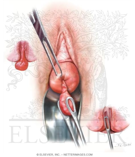 Uterine Inversion