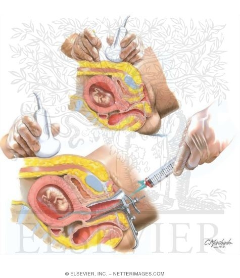 Chorionic Villus Sampling