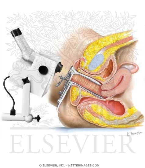 Watermarked preview of unlabeled image: Colposcopy