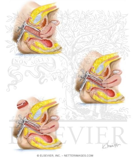 Watermarked preview of unlabeled image: Dilation and Curettage