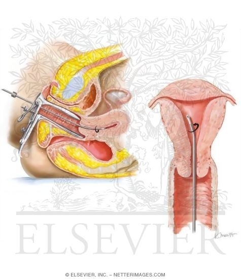 Watermarked preview of unlabeled image: Endometrial Biopsy