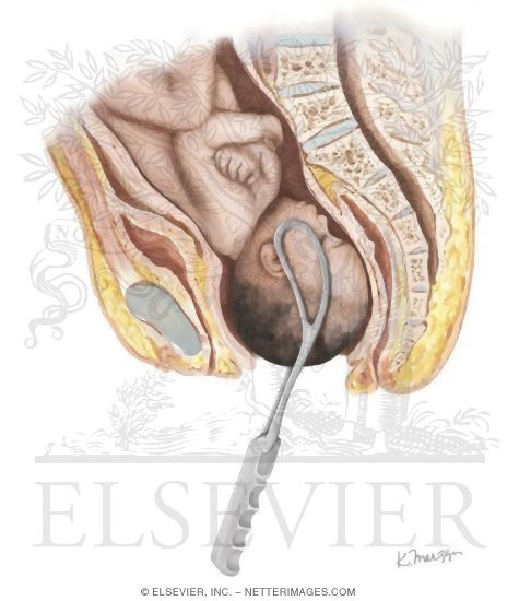 Watermarked preview of unlabeled image: Forceps Aided Delivery