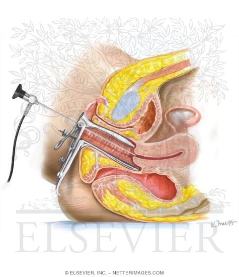 Watermarked preview of unlabeled image: Hysteroscopy