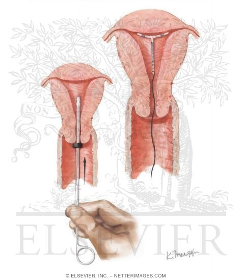 Intrauterine Contraceptive Device (IUCD) Insertion