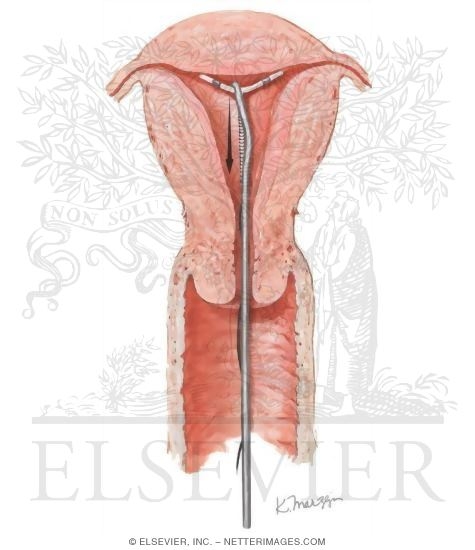Watermarked preview of unlabeled image: Intrauterine Contraceptive Device (IUCD) Removal