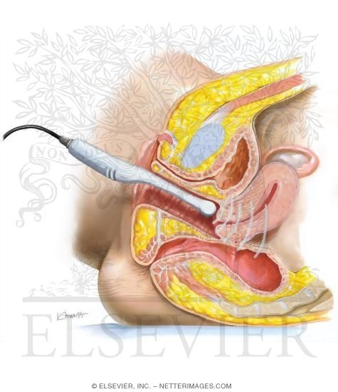 Watermarked preview of unlabeled image: Transvaginal Ultrasonography