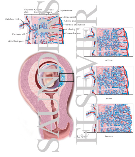 Abnormalities of Placental Implantation
