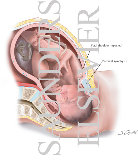 Watermarked preview of labeled image: Shoulder Dystocia