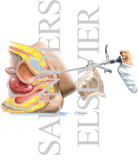 Cystourethroscopy