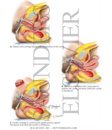 Watermarked preview of labeled image: Dilation and Curettage