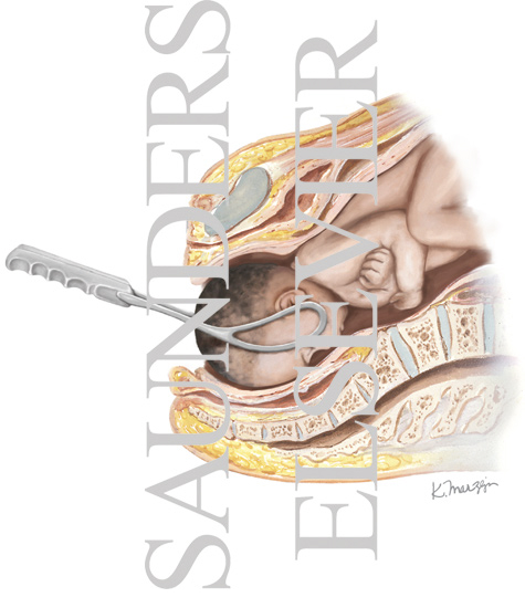 Watermarked preview of labeled image: Forceps Aided Delivery