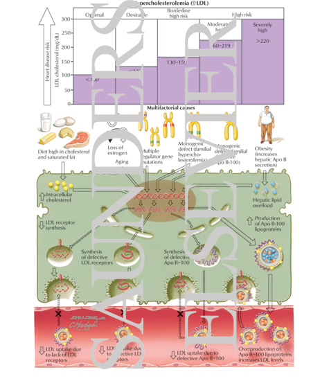 Watermarked preview of labeled image: Hypercholesterolemia 