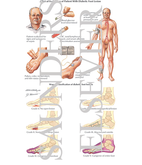 Watermarked preview of labeled image: Clinical Evaluation of Patient with Diabetic Foot Lesion