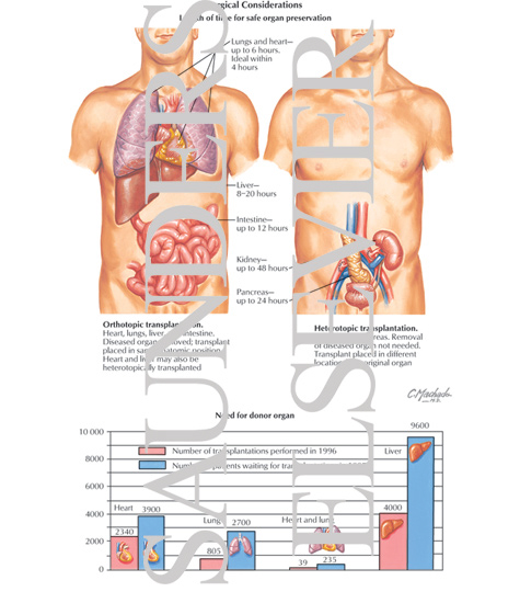 Watermarked preview of labeled image: Transplant: Surgical Considerations