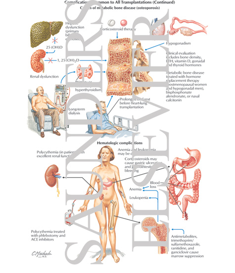 Watermarked preview of labeled image: Complications Common to All Transplantations