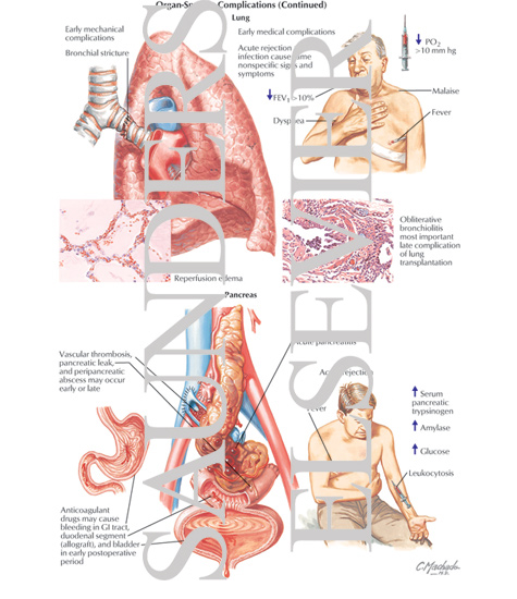 Watermarked preview of labeled image: Organ-Specific Complications