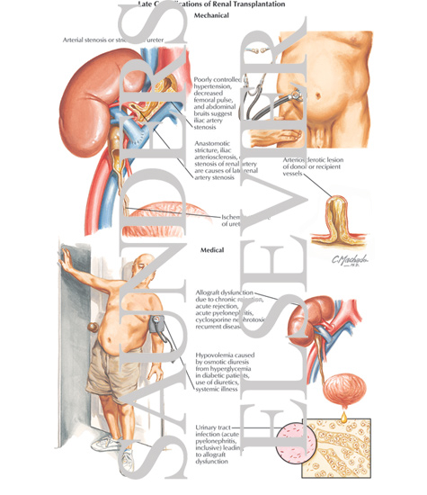 Watermarked preview of labeled image: Late Complications of Renal Transplantation