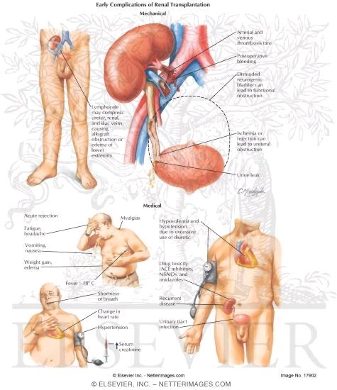 Watermarked preview of labeled image: Early Complications of Renal Transplantation