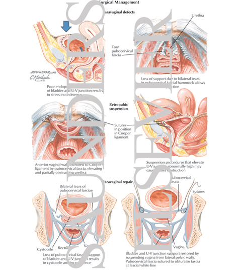 Watermarked preview of labeled image: Surgical Management of Urinary Incontinence