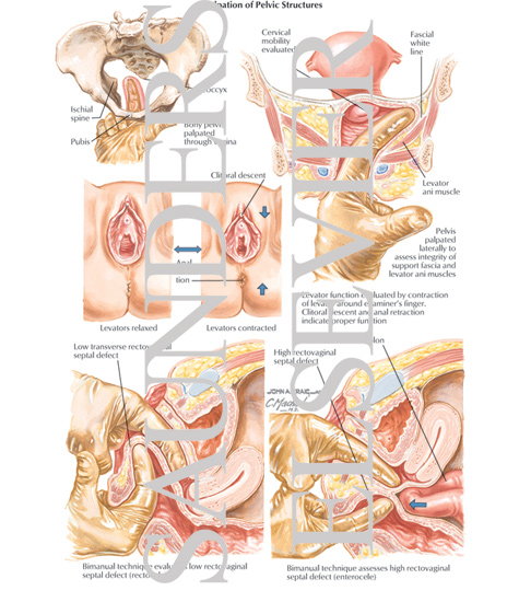 Watermarked preview of labeled image: Palpation of Pelvic Structures