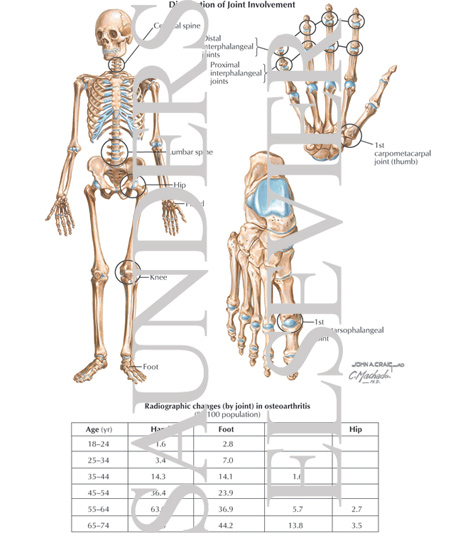 Watermarked preview of labeled image: Distribution of Joint Involvement