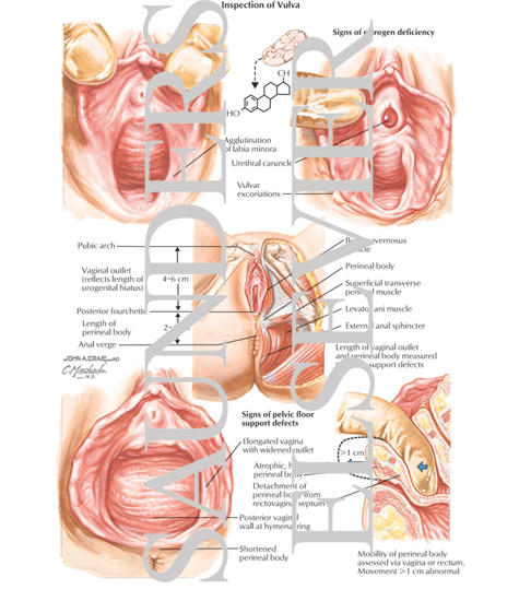 Watermarked preview of labeled image: Inspection of Vulva