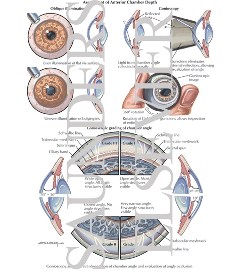 Assessment of Anterior Chamber Depth