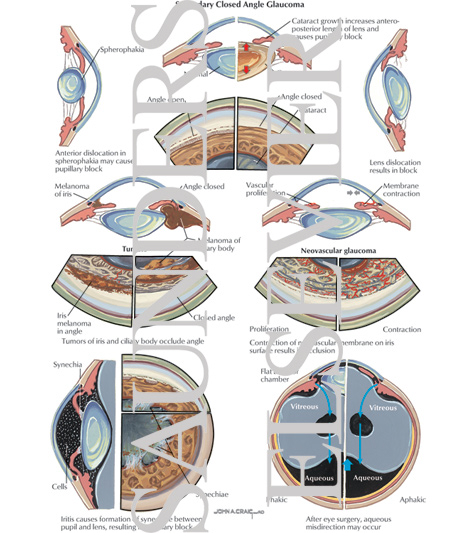 GLAUCOMA 第2版 volume 2のみ Amazon.co.jp: Glaucoma: 2-Volume Set (English Edition) 電子