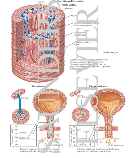 Urethral Mucosal Coaptation
