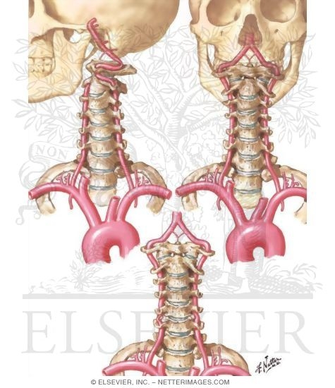 Compression of Vertebral Arteries