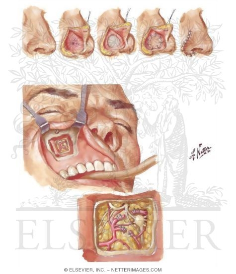 Nasal Bleeding