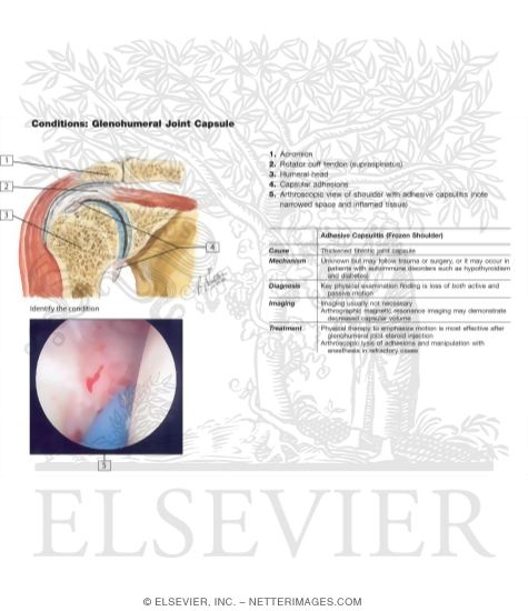 Watermarked preview of labeled image: Adhesive Capsulitis of Shoulder (Frozen Shoulder)