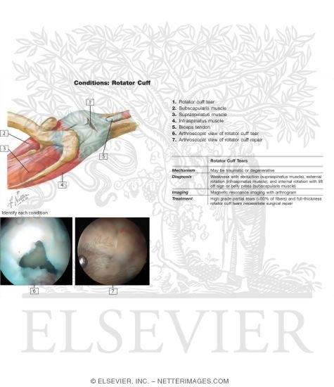 Watermarked preview of labeled image: Tears and Ruptures of Rotator Cuff