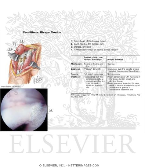 Watermarked preview of unlabeled image: Rupture of Biceps Brachii Muscle