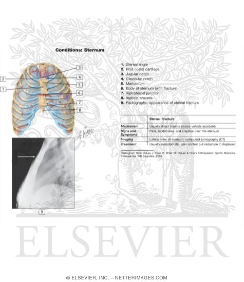 Watermarked preview of labeled image: Thoracic Cage Injuries