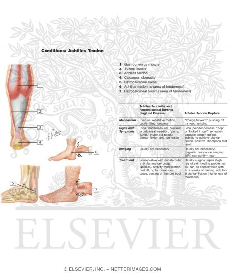 Watermarked preview of labeled image: Achilles Tendinitis: Retrocalcaneal Bursitis