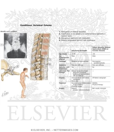 Watermarked preview of labeled image: Ankylosing Spondylitis