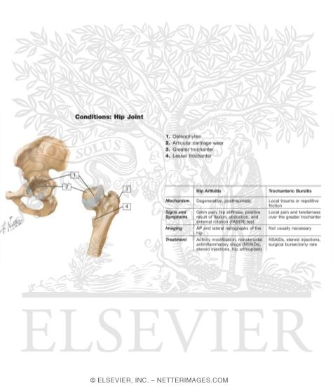 Watermarked preview of labeled image: Hip Joint Involvement in Osteoarthritis