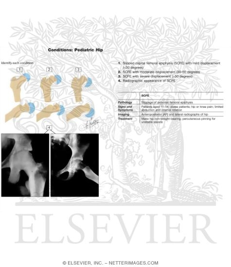 Watermarked preview of labeled image: Slipped Capital Femoral Epiphysis