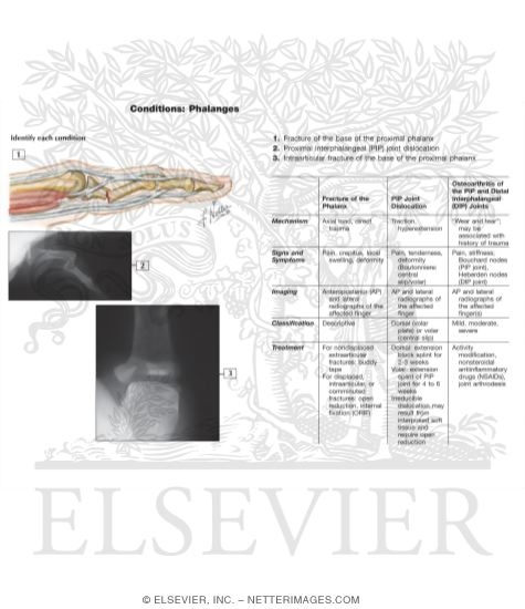 Watermarked preview of labeled image: Fracture of Proximal and Middle Phalanges
