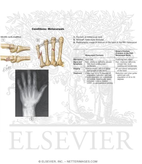 Watermarked preview of labeled image: Fracture of Metacarpals