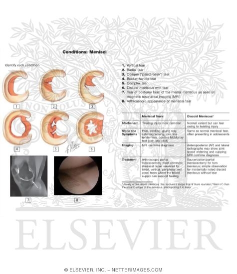 Types of Meniscal Tears