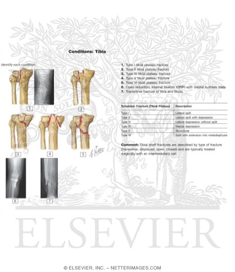Watermarked preview of labeled image: Tibial Plateau Fractures
